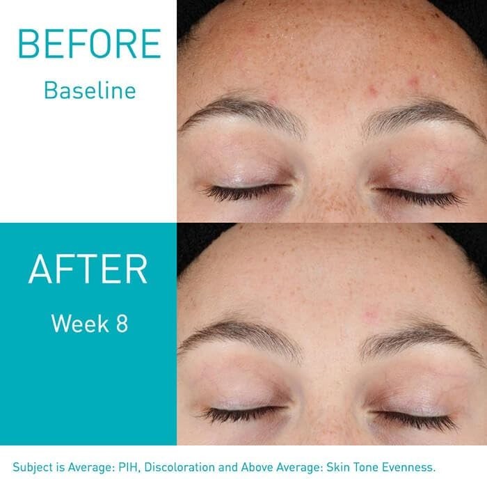 CeraVe Retinol Serum for Post-Acne Marks and Skin Texture | Pore Refining, Resurfacing, Brightening Facial Serum with Retinol and Niacinamide | Fragrance Free, Paraben Free & Non-Comedogenic| 1 Oz