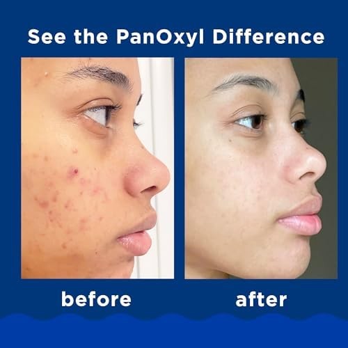Unlock Clear, Radiant Skin with PanOxyl Acne Foaming Wash: Maximum Strength Benzoyl Peroxide for Effective Acne Treatment